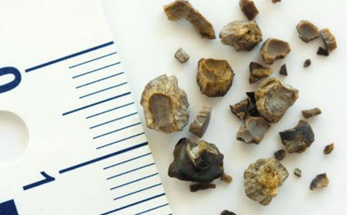 ����ʯ����ô�γɵ� ����ʯ֢״